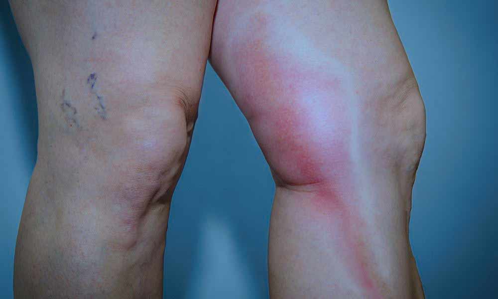 flebitis